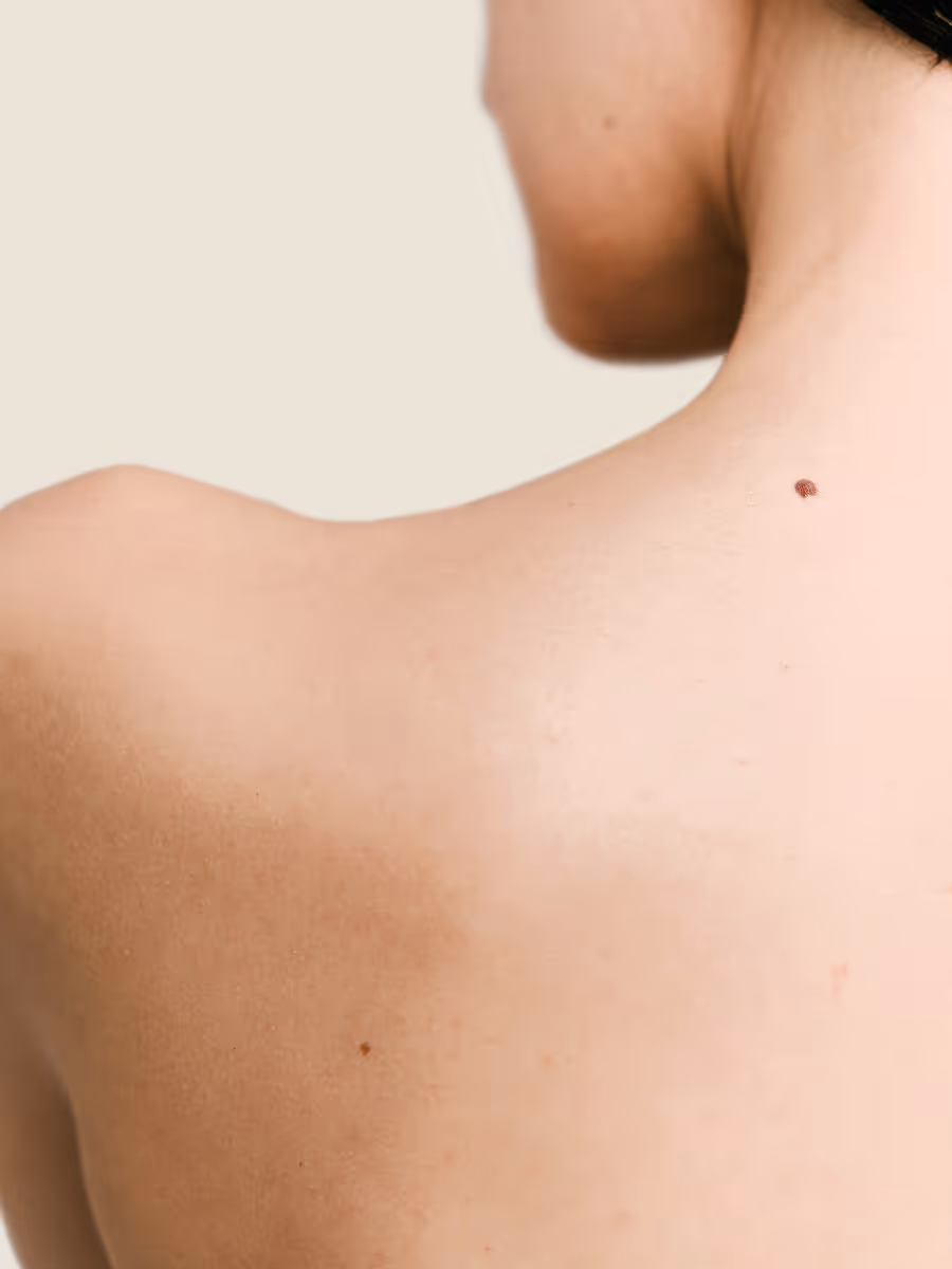 Gros plan sur l'épaule et la nuque d'une personne avec un grain de beauté visible sur la peau claire.